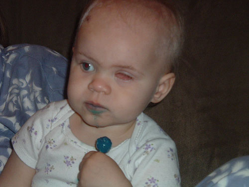 Rowan enjoying a blue lollipop and missing her left eye.