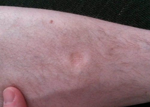 An image of a scar on Chris' leg from the hit and run incident